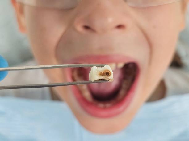 Best Emergency Dentist for Lost Fillings or Crowns in Sherwood, AR